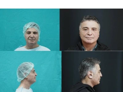 Bitlis'te ilk kez "derin plan y&uuml;z germe ameliyatı" yapıldı