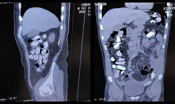 Siirt'in komşu ilinde mide ve bağırsaklarında uyuşturucu tespit edilen yabancı uyruklu 2 şüpheli tutuklandı