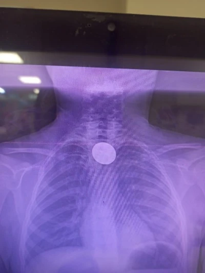 Siirt&rsquo;te Madeni Para Yutan &Ccedil;ocuğun Boğazındaki Para &Ccedil;ıkarıldı